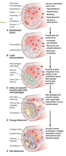 what is the impact of arteriosclerosis quizlet topic test|arteriosclerosis is characterized by quizlet.